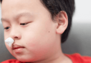 hidung berdarah