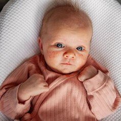 Jerawat Bayi: Punca, Cara Merawat dan Produk Penjagaan Kulit Bayi Yang Sesuai