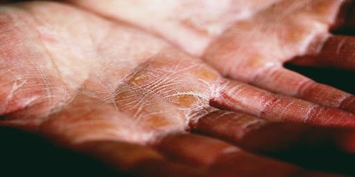 Anda Ingin Tahu Jenis Masalah Kulit Kering? Jom Baca Artikel Ini
