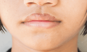 simptom influenza: bibir kering
